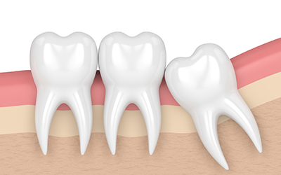 Impacted wisdom teeth